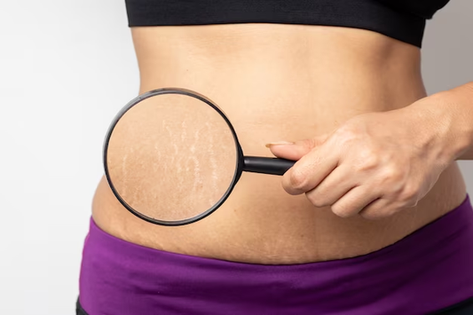 Tretinoin on Old Stretch Marks: Examining the Effectiveness